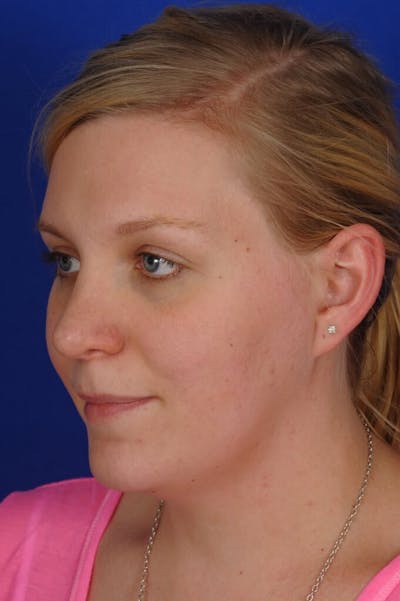 Revision Rhinoplasty Before & After Gallery - Patient 345881 - Image 2