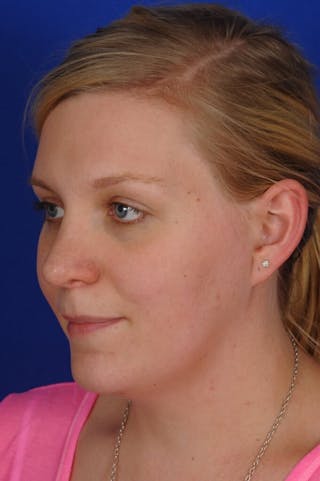 Revision Rhinoplasty Before & After Gallery - Patient 345881 - Image 2