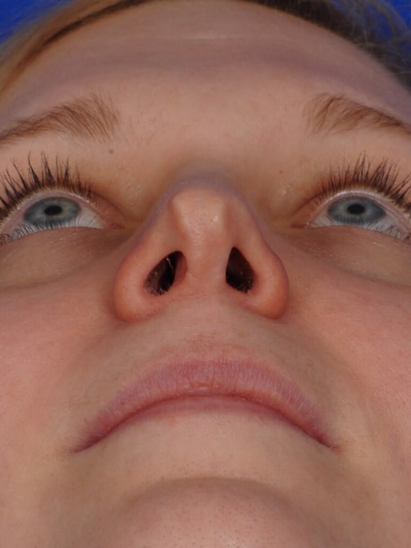 Revision Rhinoplasty Before & After Gallery - Patient 345881 - Image 3