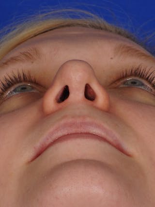 Revision Rhinoplasty Before & After Gallery - Patient 345881 - Image 4