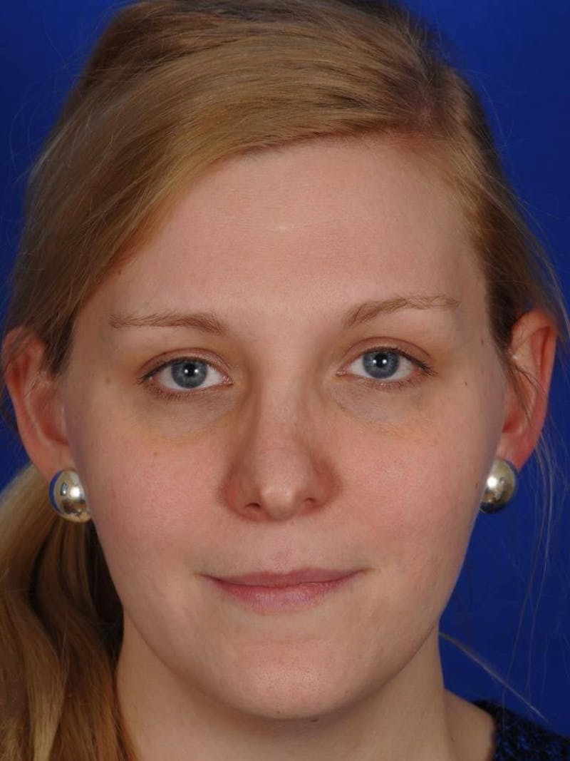 Revision Rhinoplasty Before & After Gallery - Patient 345881 - Image 5