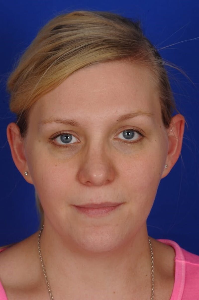 Revision Rhinoplasty Before & After Gallery - Patient 345881 - Image 6