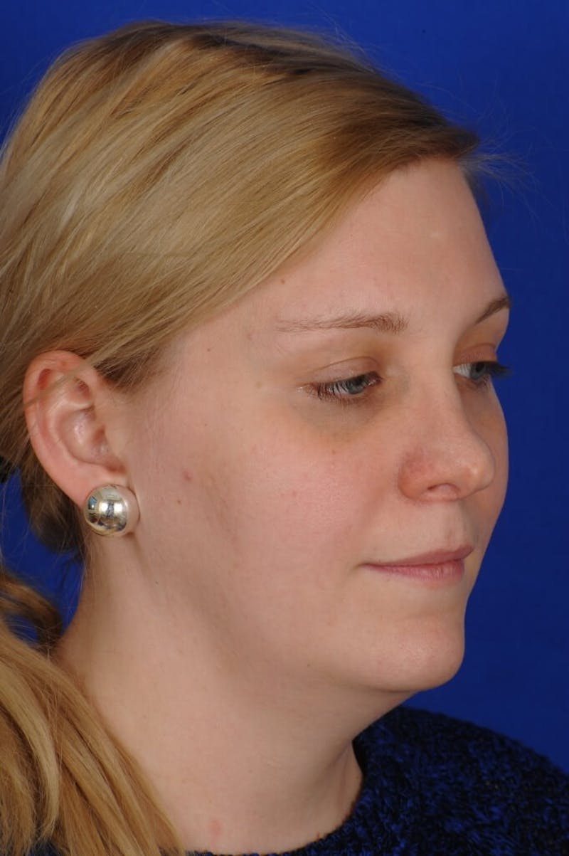 Revision Rhinoplasty Before & After Gallery - Patient 345881 - Image 7