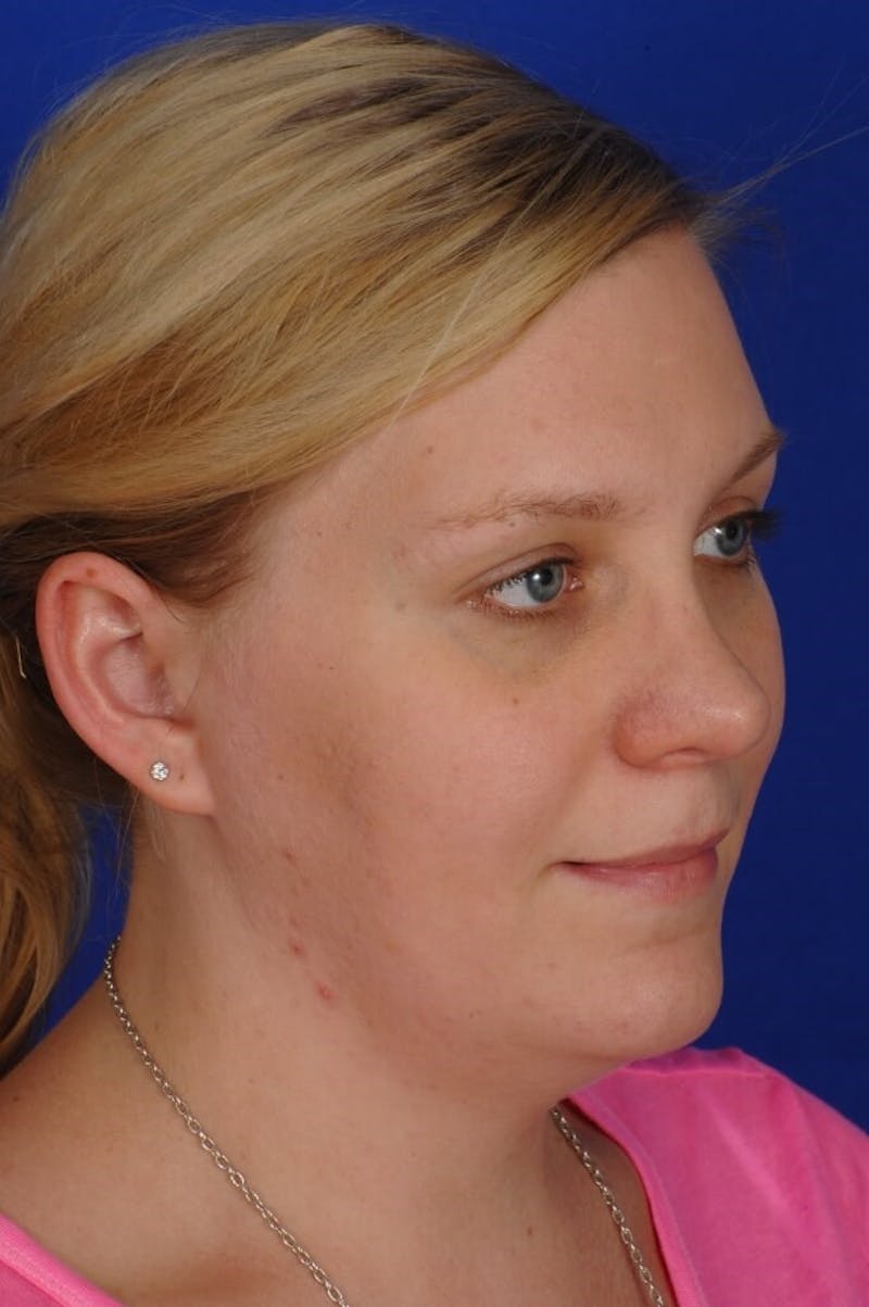 Revision Rhinoplasty Before & After Gallery - Patient 345881 - Image 8