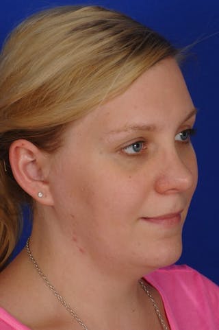 Revision Rhinoplasty Before & After Gallery - Patient 345881 - Image 8