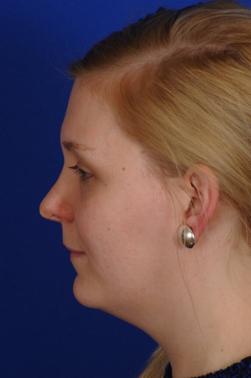 Revision Rhinoplasty Before & After Gallery - Patient 345881 - Image 9