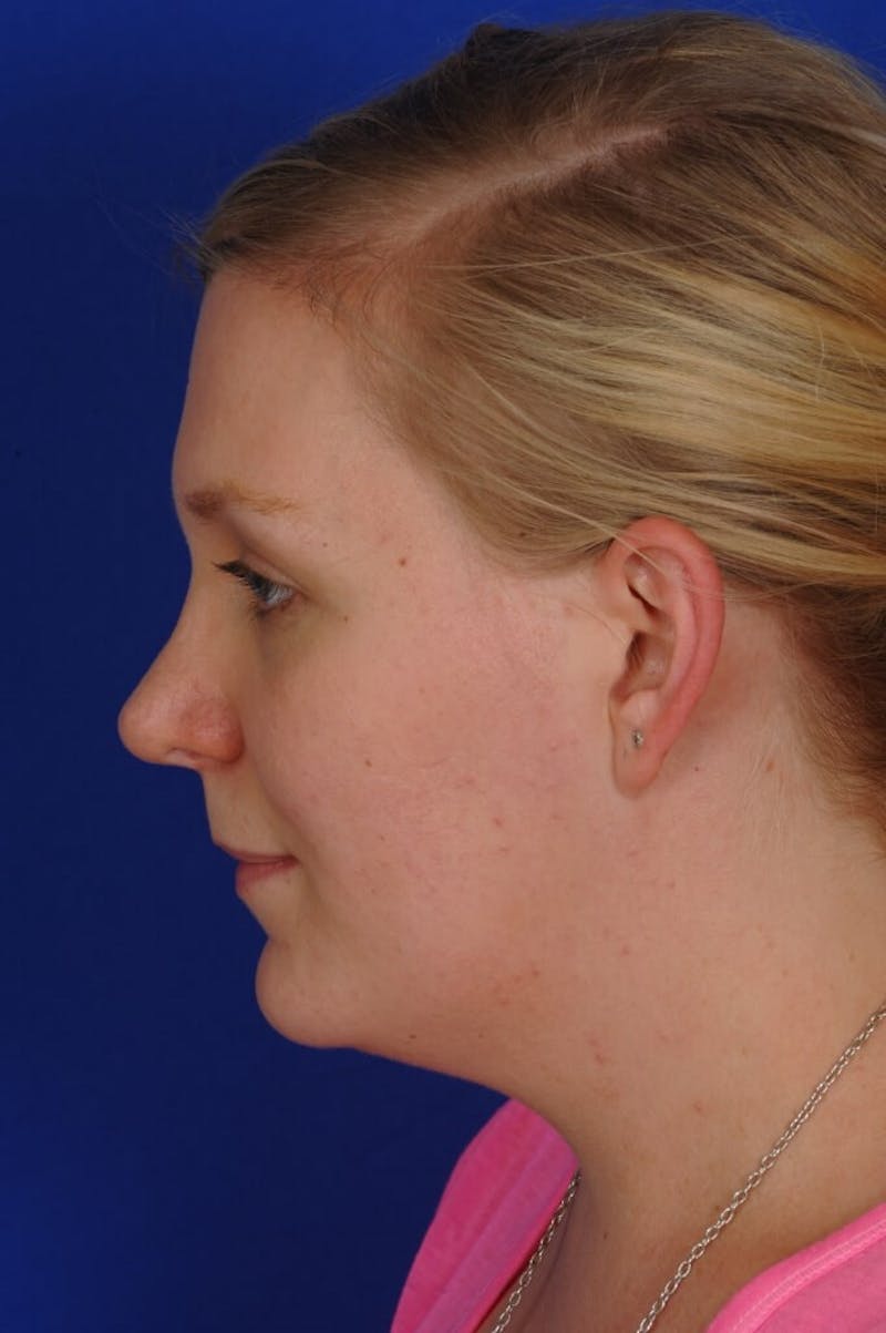 Revision Rhinoplasty Before & After Gallery - Patient 345881 - Image 10