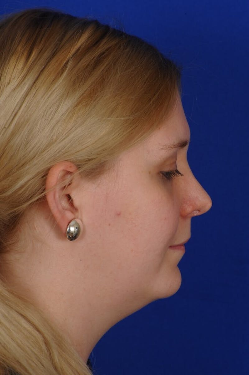Revision Rhinoplasty Before & After Gallery - Patient 345881 - Image 11