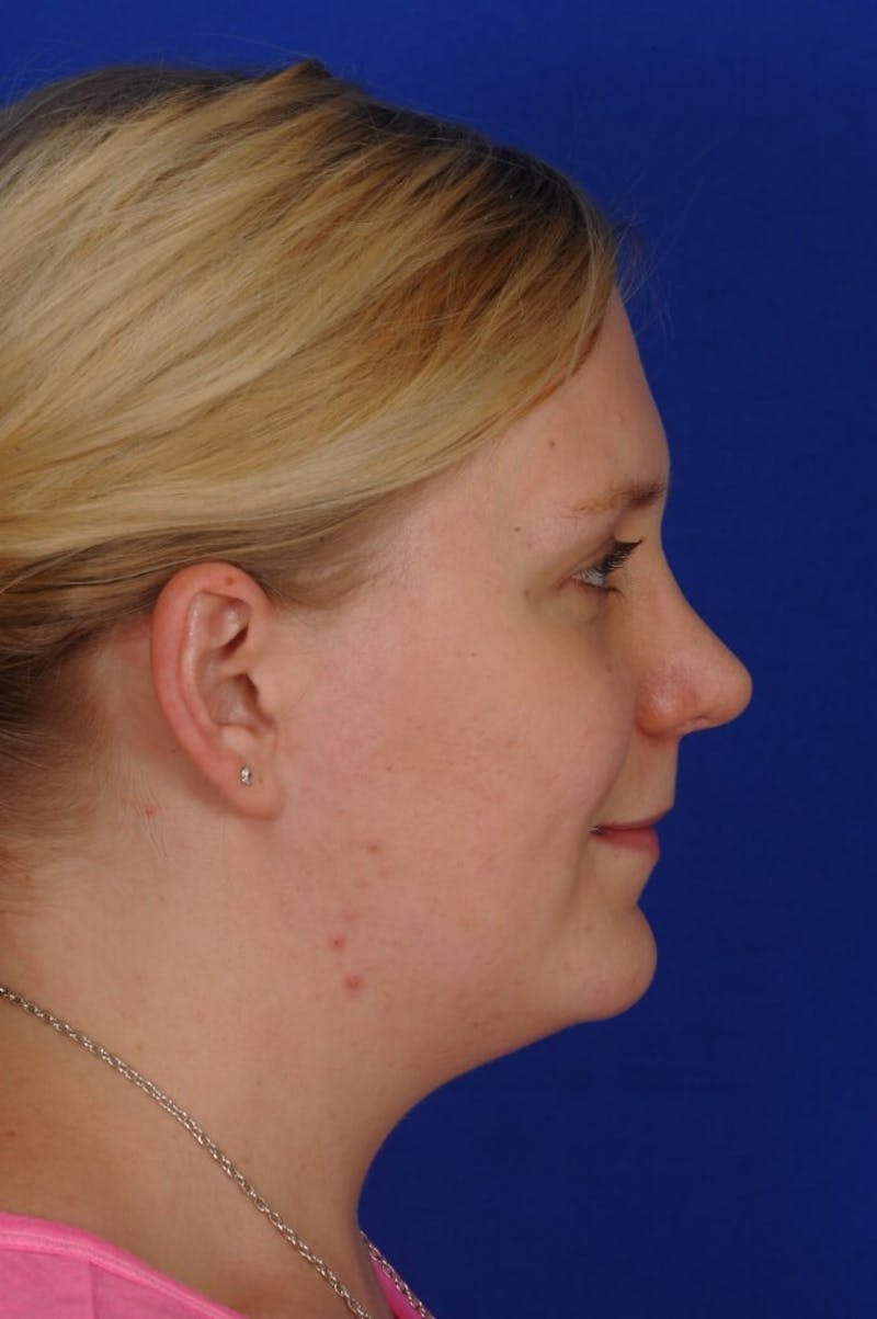 Revision Rhinoplasty Before & After Gallery - Patient 345881 - Image 12