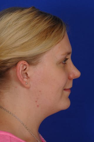 Revision Rhinoplasty Before & After Gallery - Patient 345881 - Image 12
