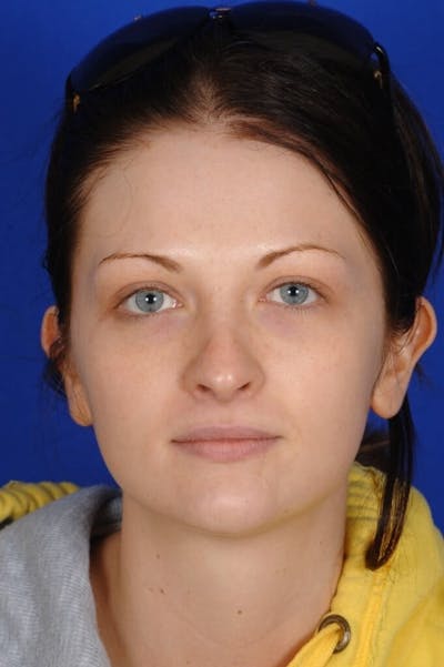 Revision Rhinoplasty Before & After Gallery - Patient 293097 - Image 1