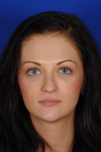 Revision Rhinoplasty Before & After Gallery - Patient 293097 - Image 2