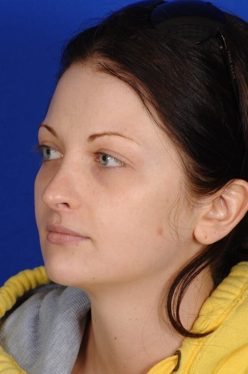 Revision Rhinoplasty Before & After Gallery - Patient 293097 - Image 3