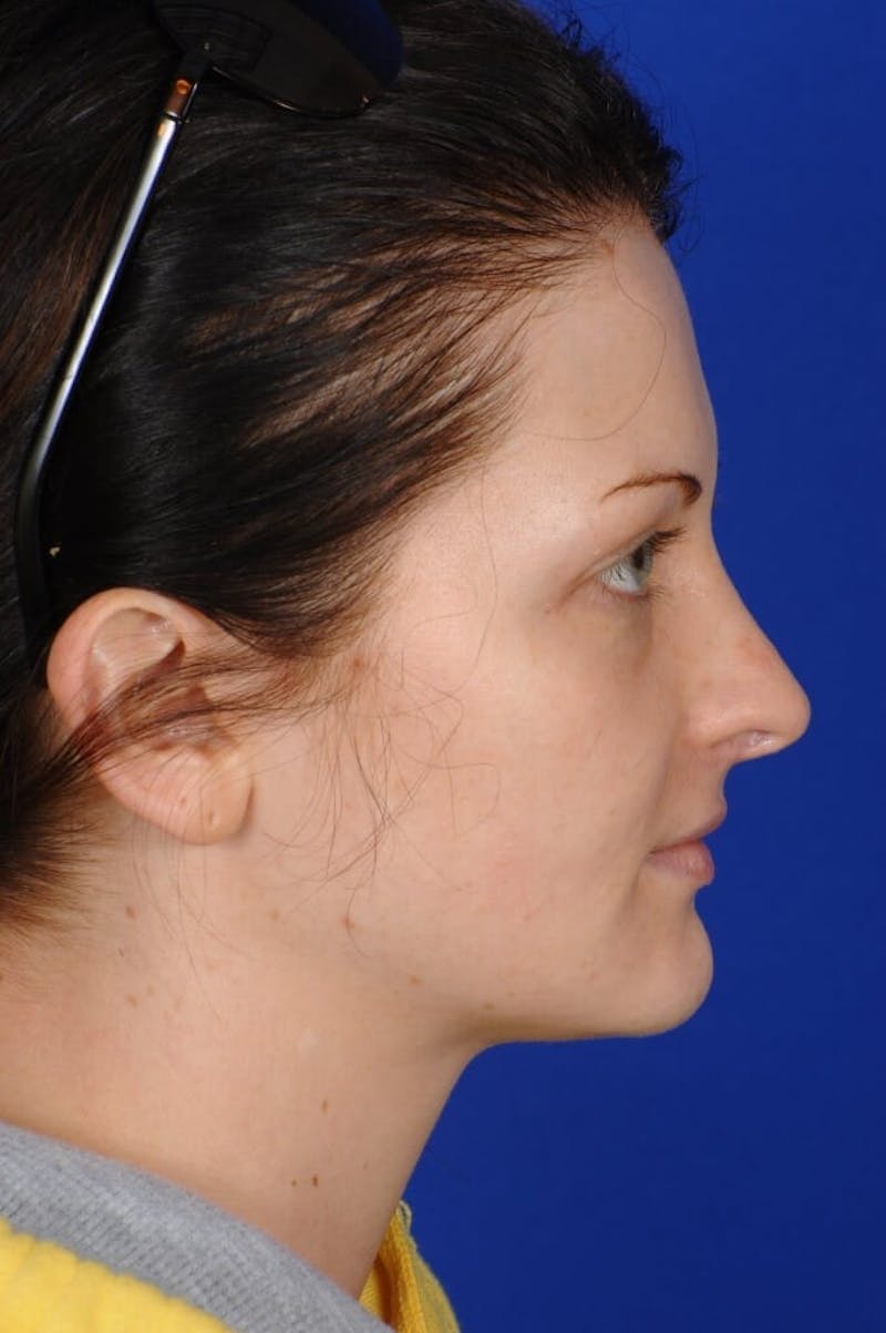 Revision Rhinoplasty Before & After Gallery - Patient 293097 - Image 5