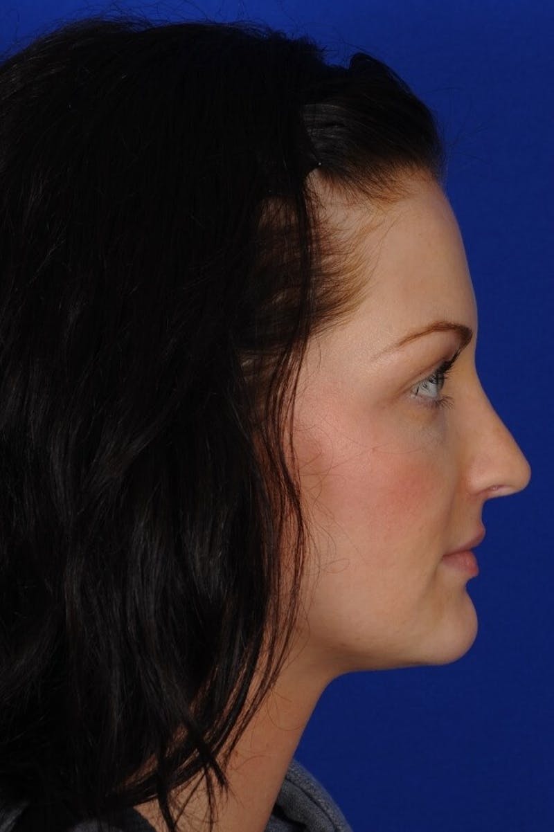 Revision Rhinoplasty Before & After Gallery - Patient 293097 - Image 6