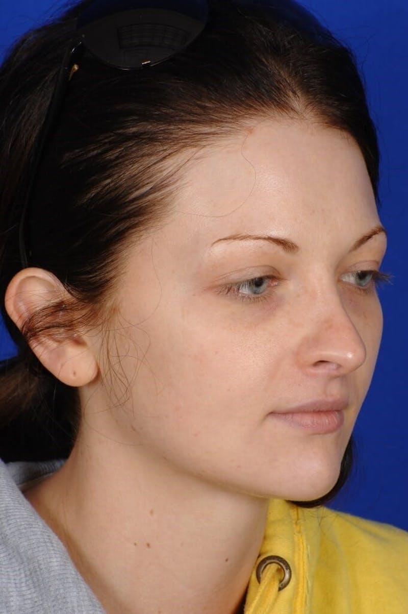 Revision Rhinoplasty Before & After Gallery - Patient 293097 - Image 7