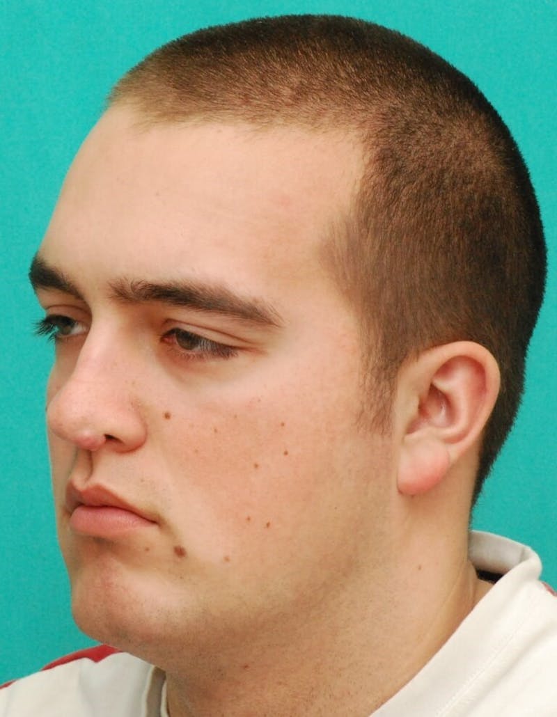 Facial Reconstruction Before & After Gallery - Patient 385937 - Image 3