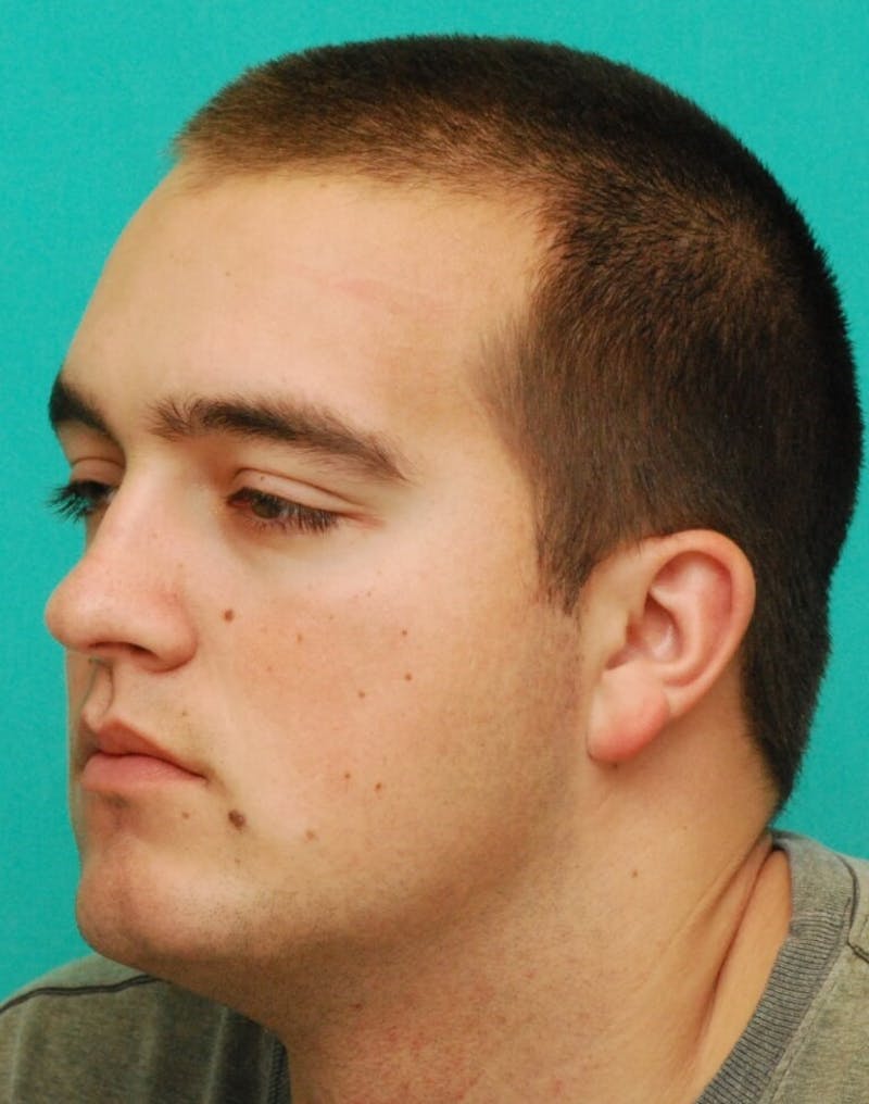 Facial Reconstruction Before & After Gallery - Patient 385937 - Image 4