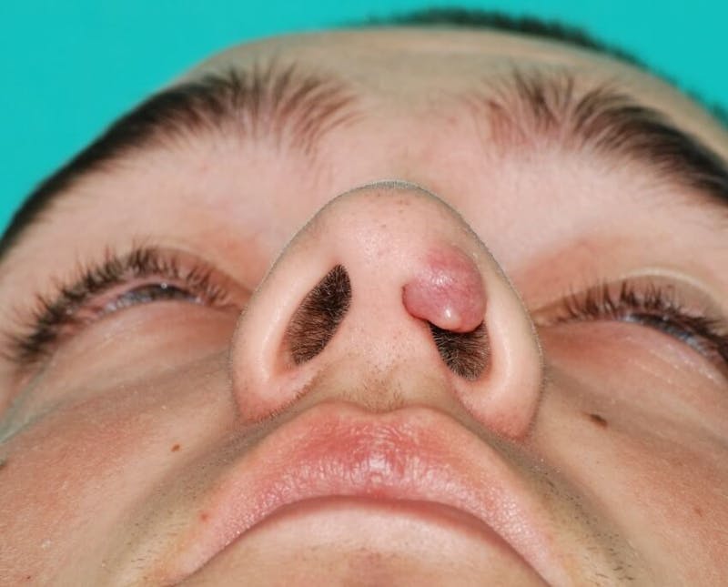 Facial Reconstruction Before & After Gallery - Patient 385937 - Image 5