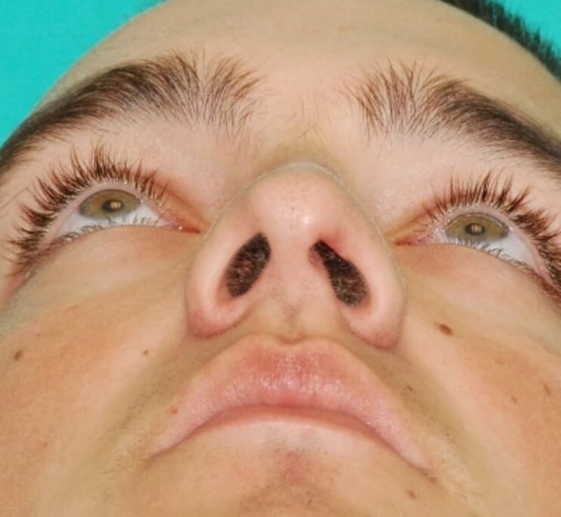 Facial Reconstruction Before & After Gallery - Patient 385937 - Image 6
