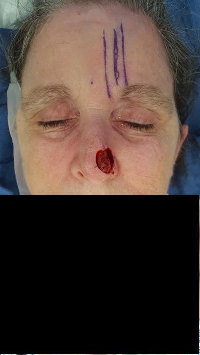 Facial Reconstruction Before & After Gallery - Patient 534946 - Image 1