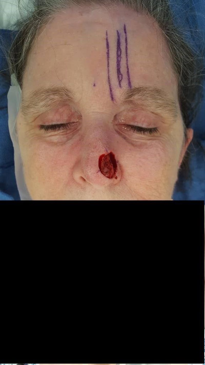 Facial Reconstruction Before & After Gallery - Patient 534946 - Image 1