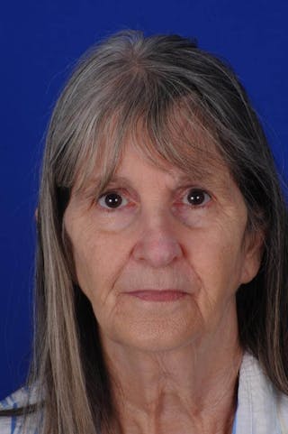 Facial Reconstruction Before & After Gallery - Patient 534946 - Image 2