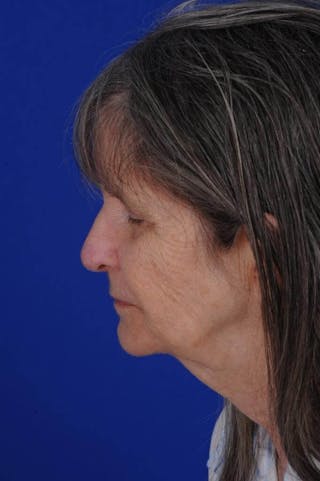 Facial Reconstruction Before & After Gallery - Patient 534946 - Image 4