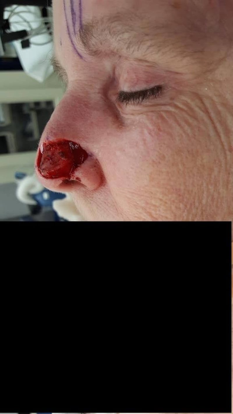 Facial Reconstruction Before & After Gallery - Patient 534946 - Image 5