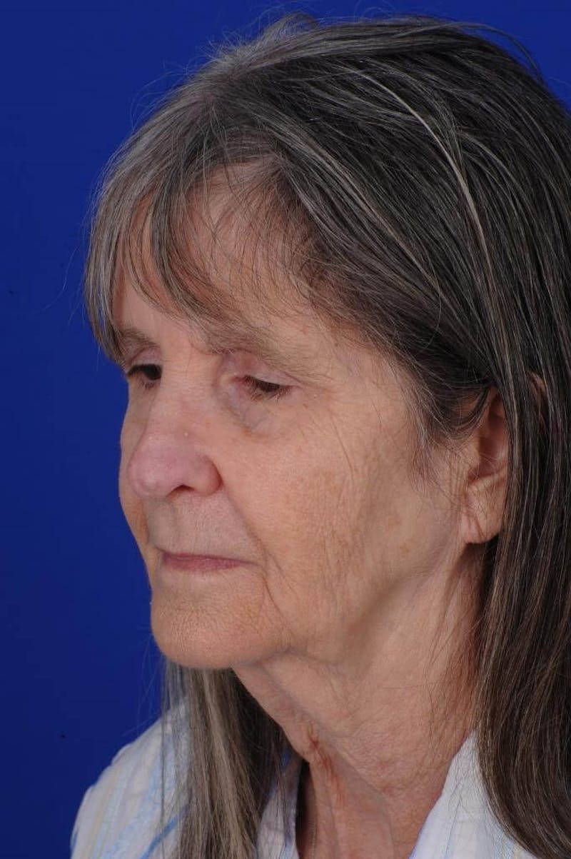 Facial Reconstruction Before & After Gallery - Patient 534946 - Image 6