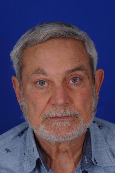 Facial Reconstruction Before & After Gallery - Patient 361297 - Image 2