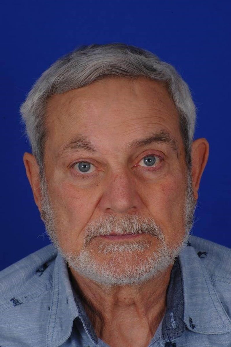 Facial Reconstruction Before & After Gallery - Patient 361297 - Image 2