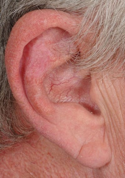 Facial Reconstruction Before & After Gallery - Patient 200754 - Image 2