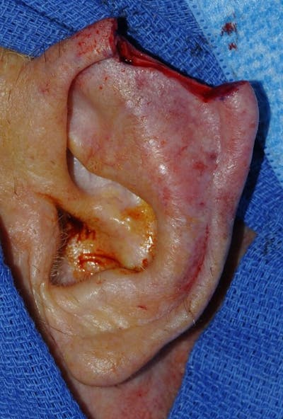 Facial Reconstruction Before & After Gallery - Patient 382010 - Image 1