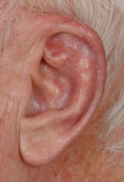 Facial Reconstruction Before & After Gallery - Patient 382010 - Image 2