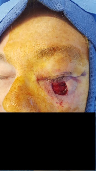 Facial Reconstruction Before & After Gallery - Patient 203058 - Image 1