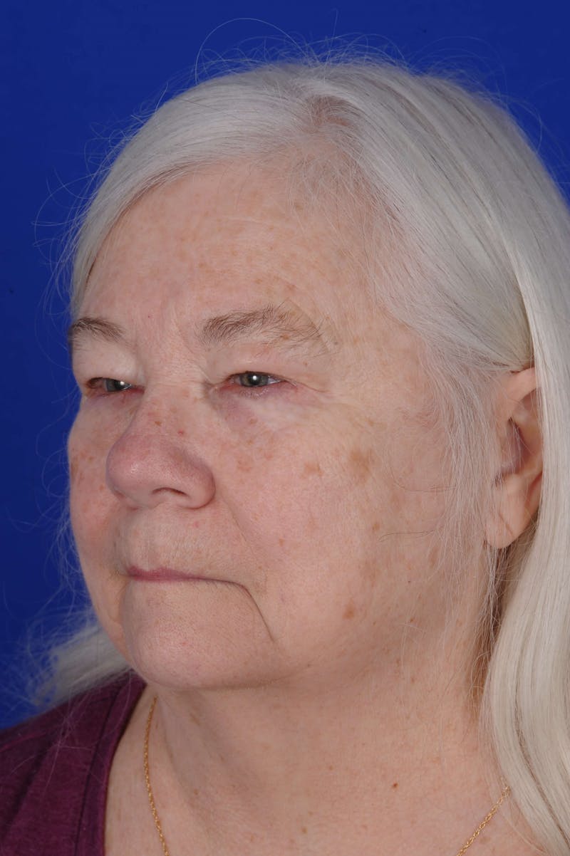 Facial Reconstruction Before & After Gallery - Patient 203058 - Image 2