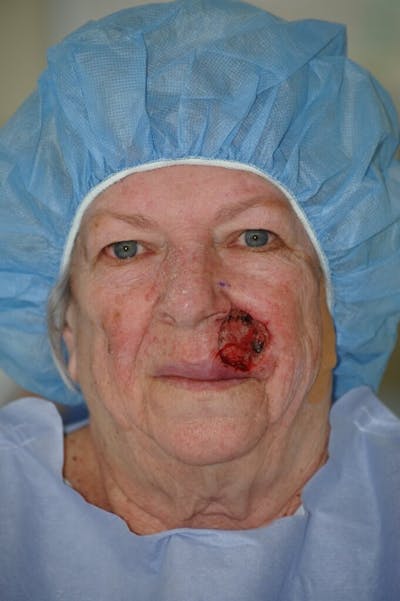 Facial Reconstruction Before & After Gallery - Patient 366121 - Image 1
