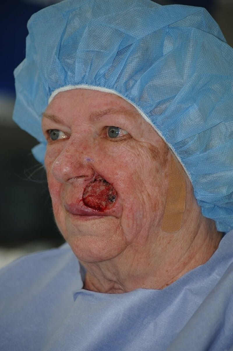 Facial Reconstruction Before & After Gallery - Patient 366121 - Image 3