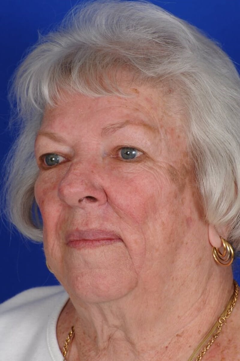 Facial Reconstruction Before & After Gallery - Patient 366121 - Image 4