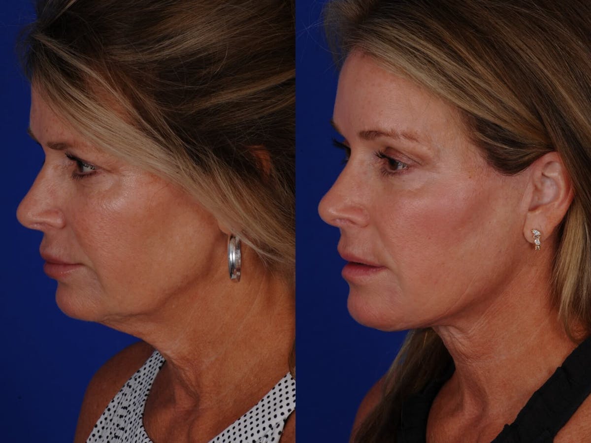 Cheek Lift Before & After Gallery - Patient 393684 - Image 1