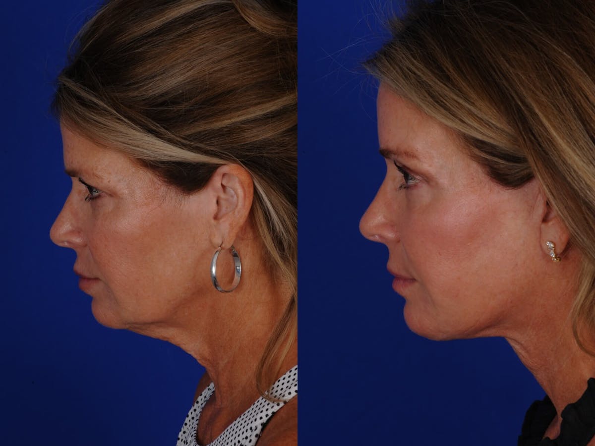 Cheek Lift Before & After Gallery - Patient 393684 - Image 2