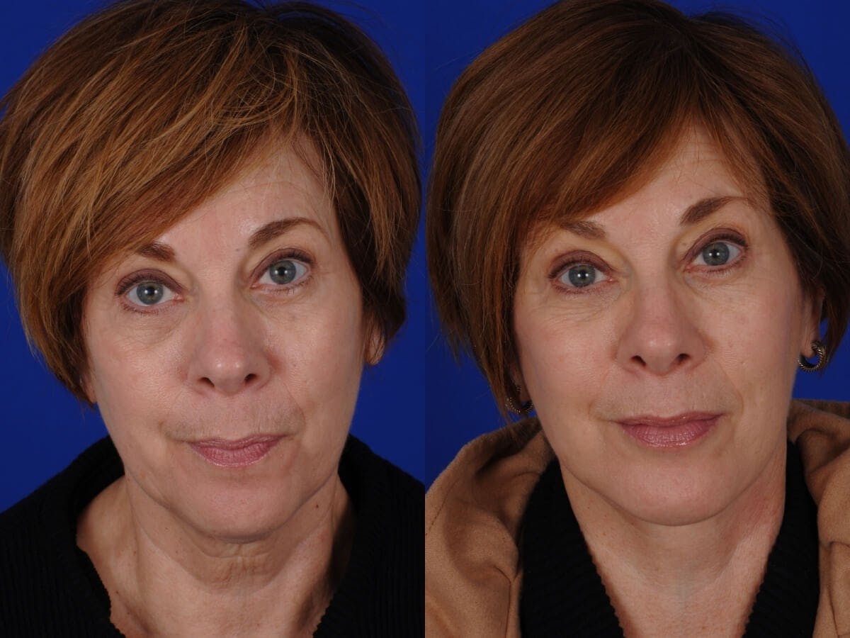 Chin Augmentation Before & After Gallery - Patient 428805 - Image 1