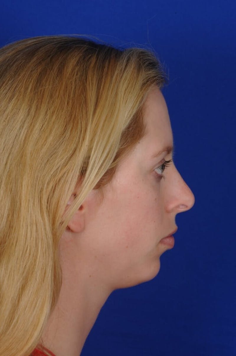 Chin Augmentation Before & After Gallery - Patient 662330 - Image 3