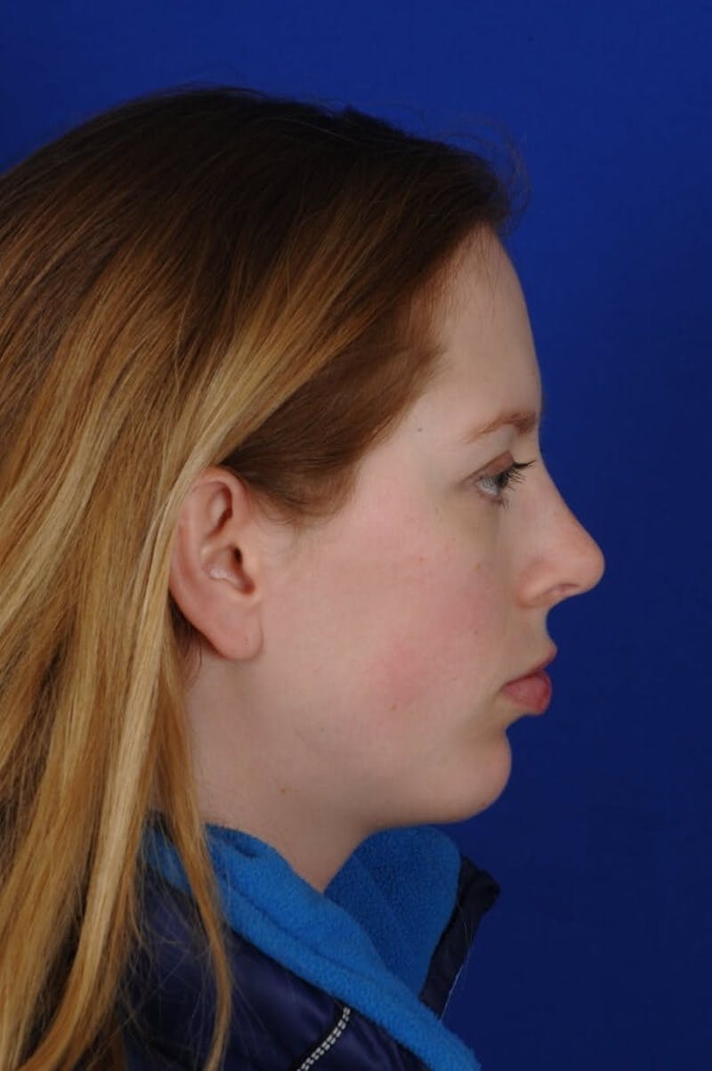 Chin Augmentation Before & After Gallery - Patient 662330 - Image 4