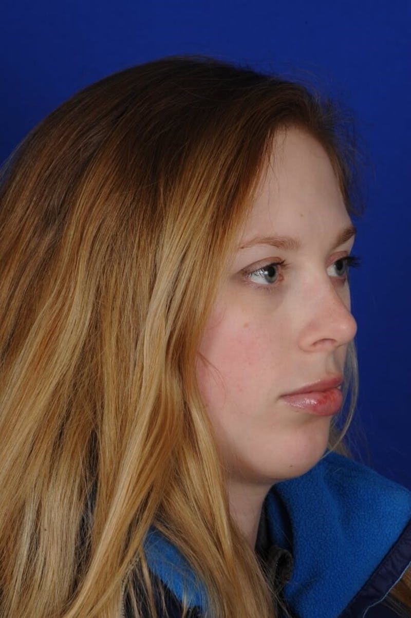 Chin Augmentation Before & After Gallery - Patient 662330 - Image 6
