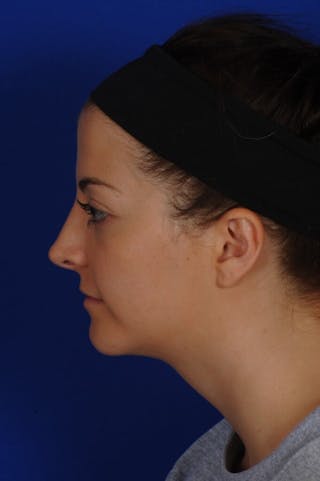 Chin Augmentation Before & After Gallery - Patient 135949 - Image 2