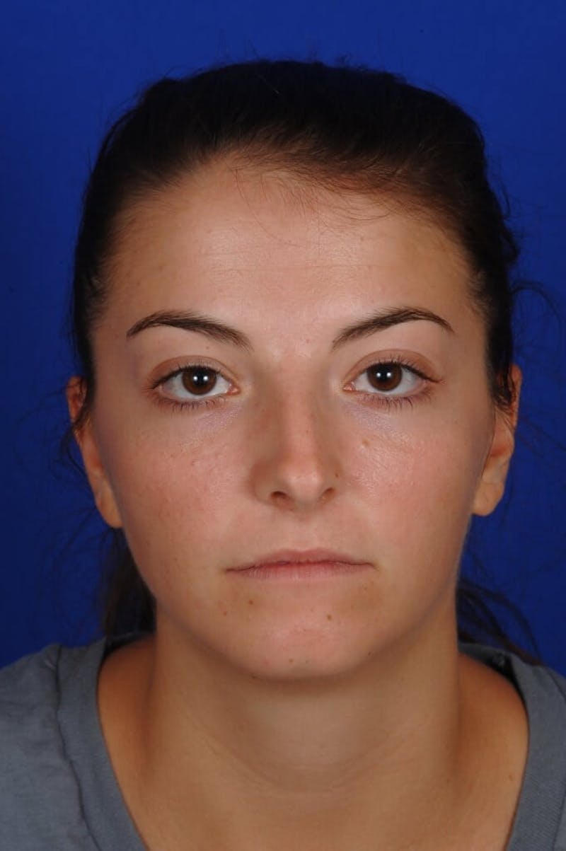 Chin Augmentation Before & After Gallery - Patient 135949 - Image 3