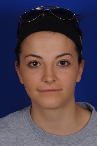 Chin Augmentation Before & After Gallery - Patient 135949 - Image 4