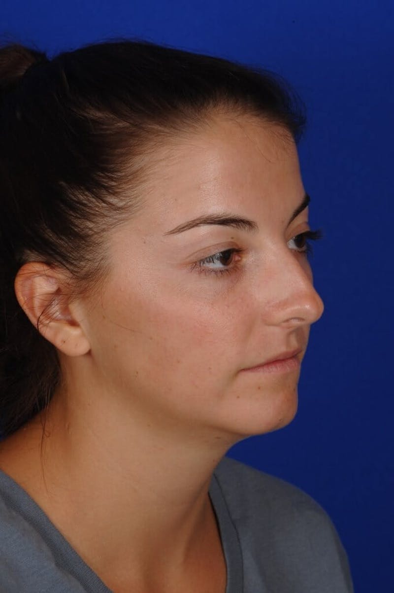 Chin Augmentation Before & After Gallery - Patient 135949 - Image 5